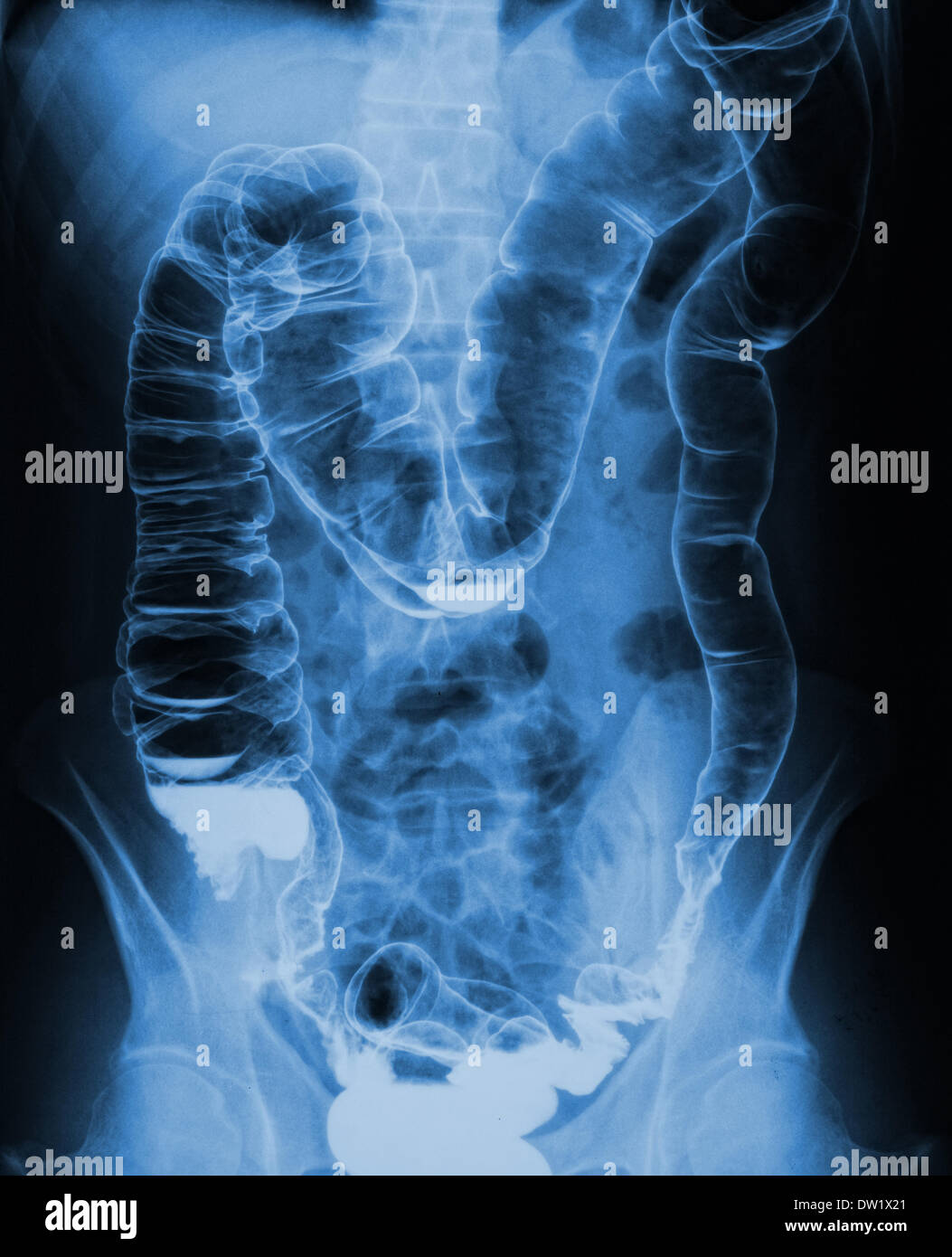 xray stock news