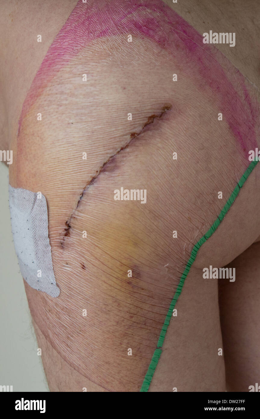 Scar after hip replacement surgery Stock Photo