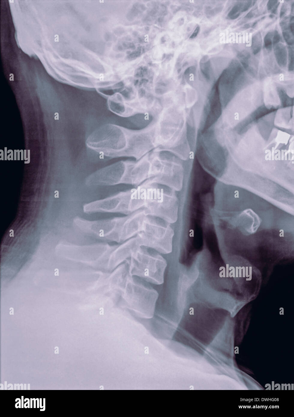 Cervical spine x-ray of a 40 year old male patient side view Stock Photo