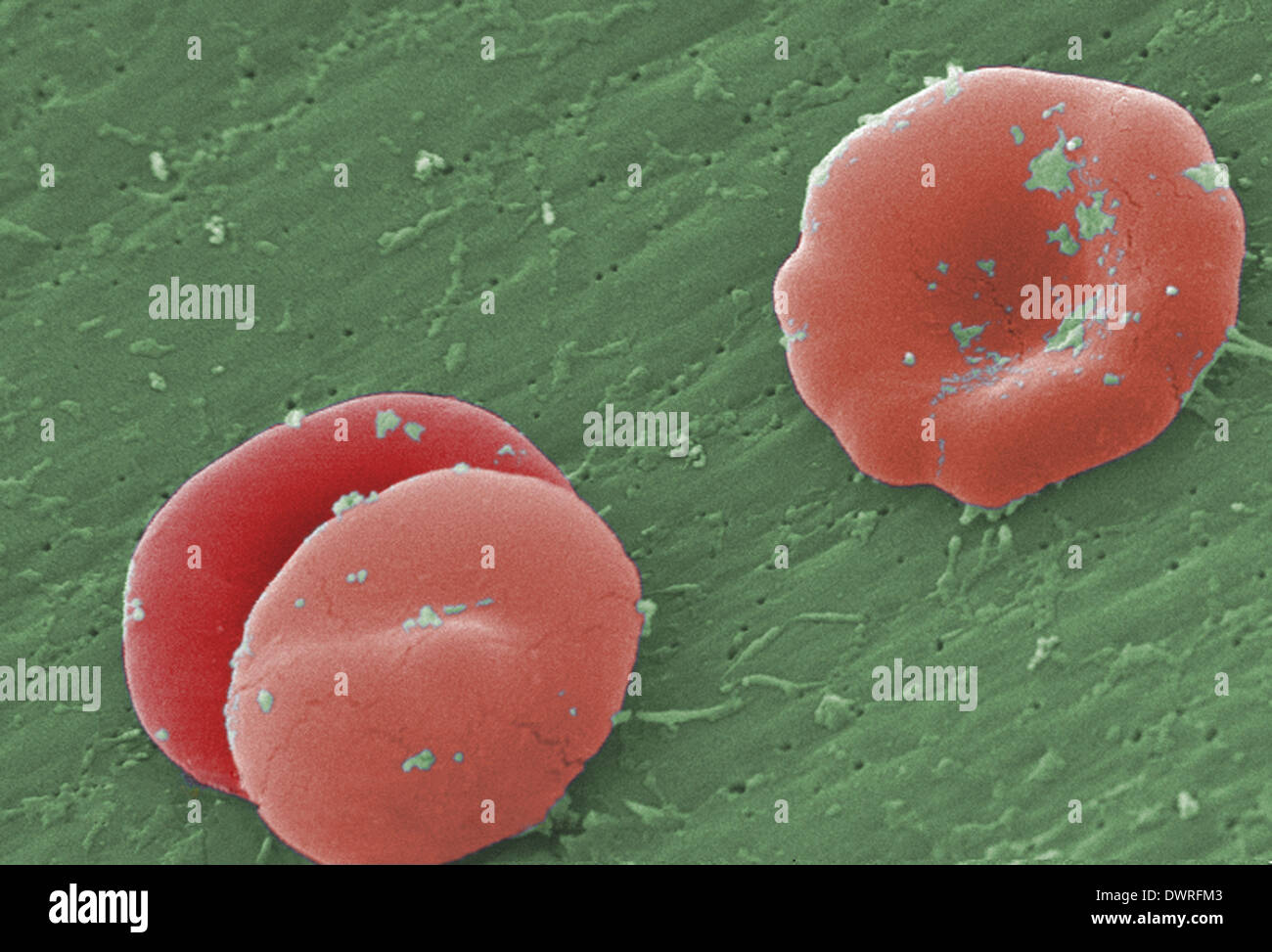 Sickle cell anemia sem Stock Photo