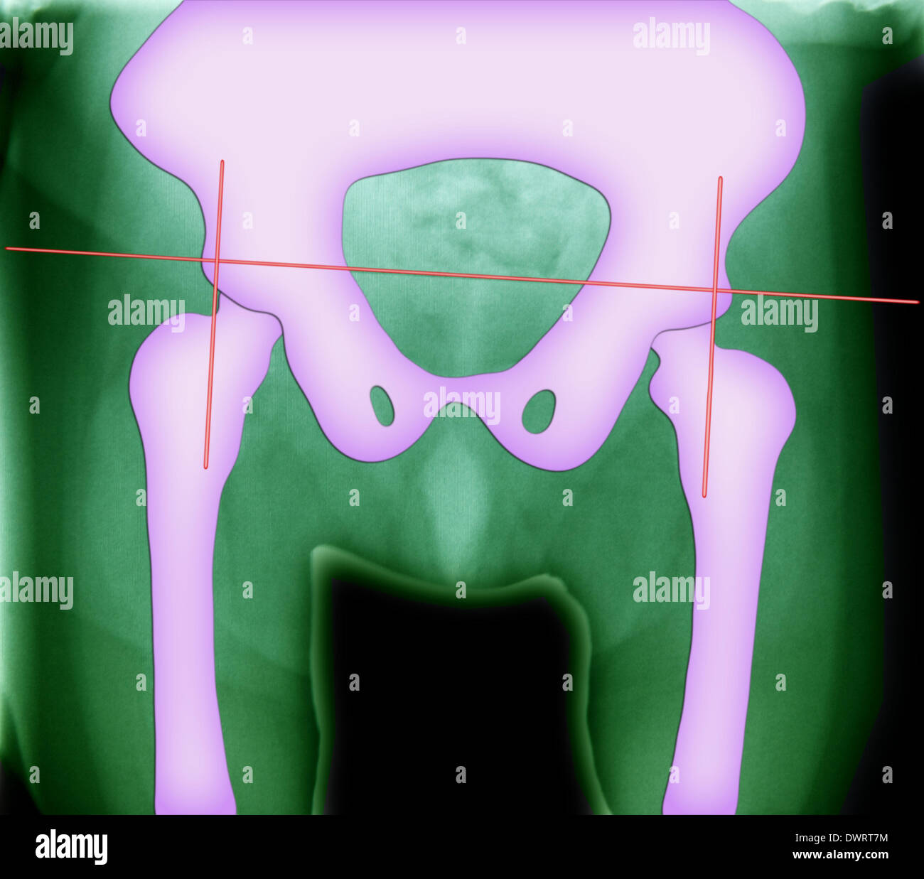 Infant head x ray hi-res stock photography and images - Alamy