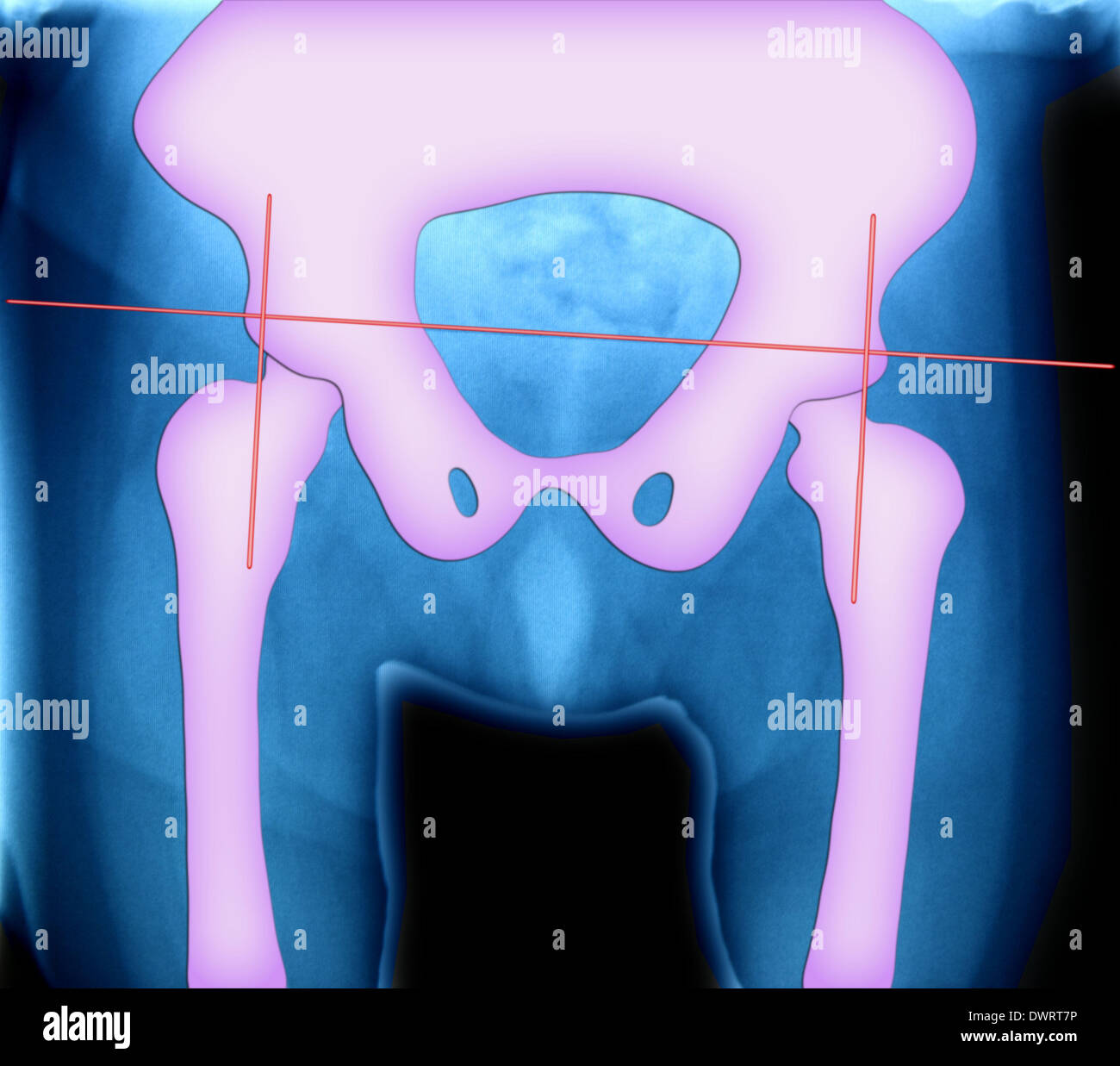 Pelvis x ray Stock Photo Alamy
