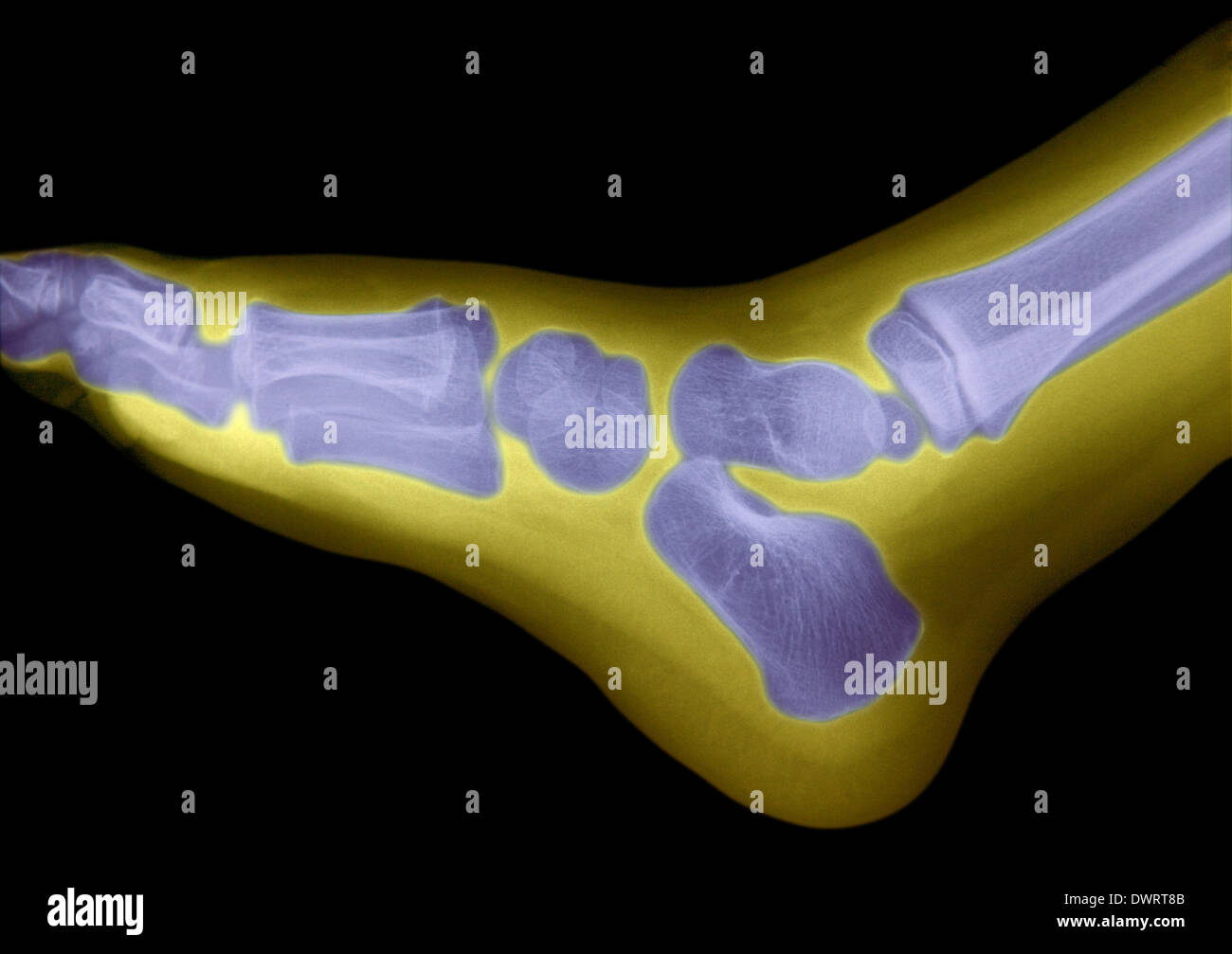 Foot x ray Stock Photo - Alamy