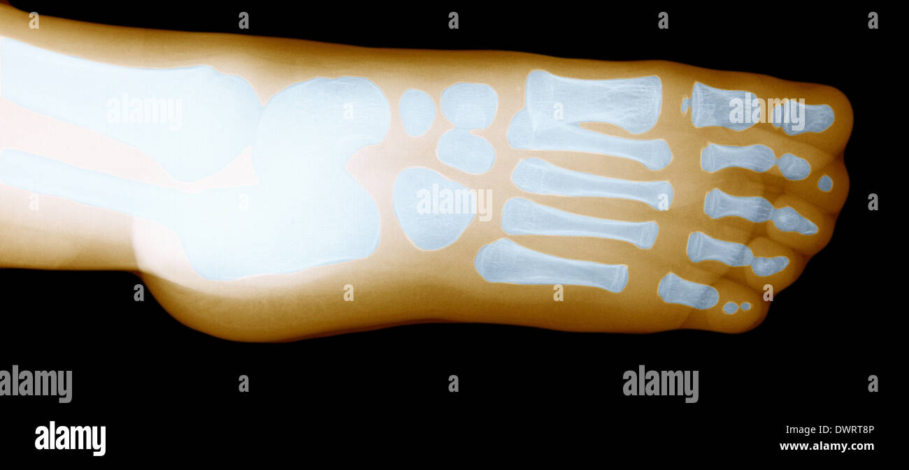 Foot x ray Stock Photo - Alamy