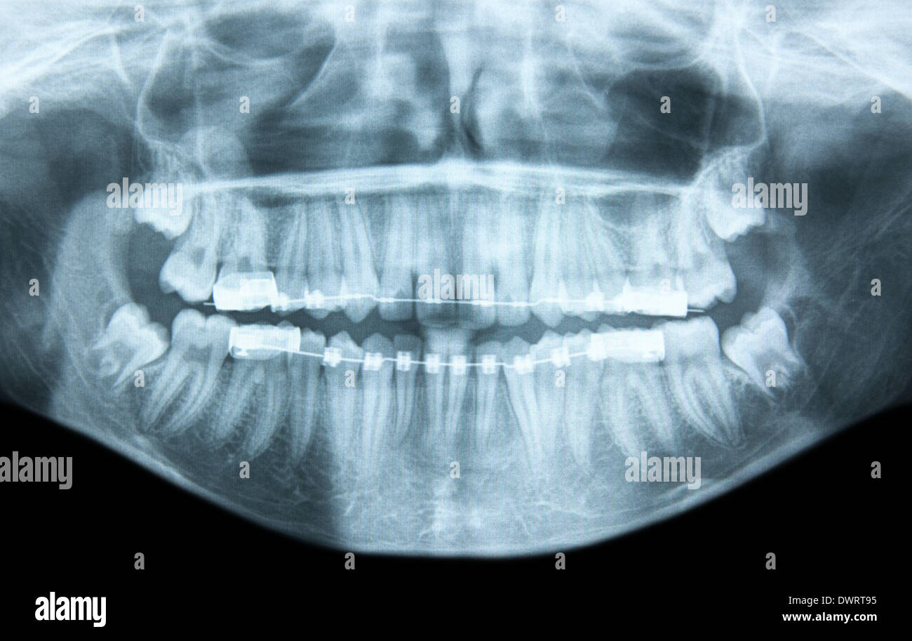 Dental apparatus Stock Photo