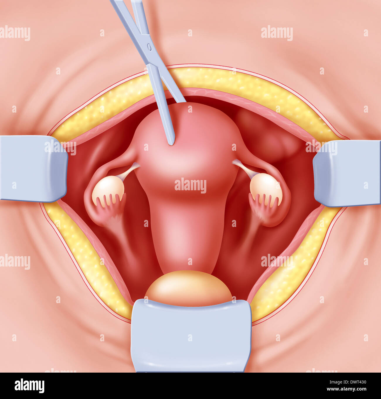 Hysterectomy hi-res stock photography and images - Alamy