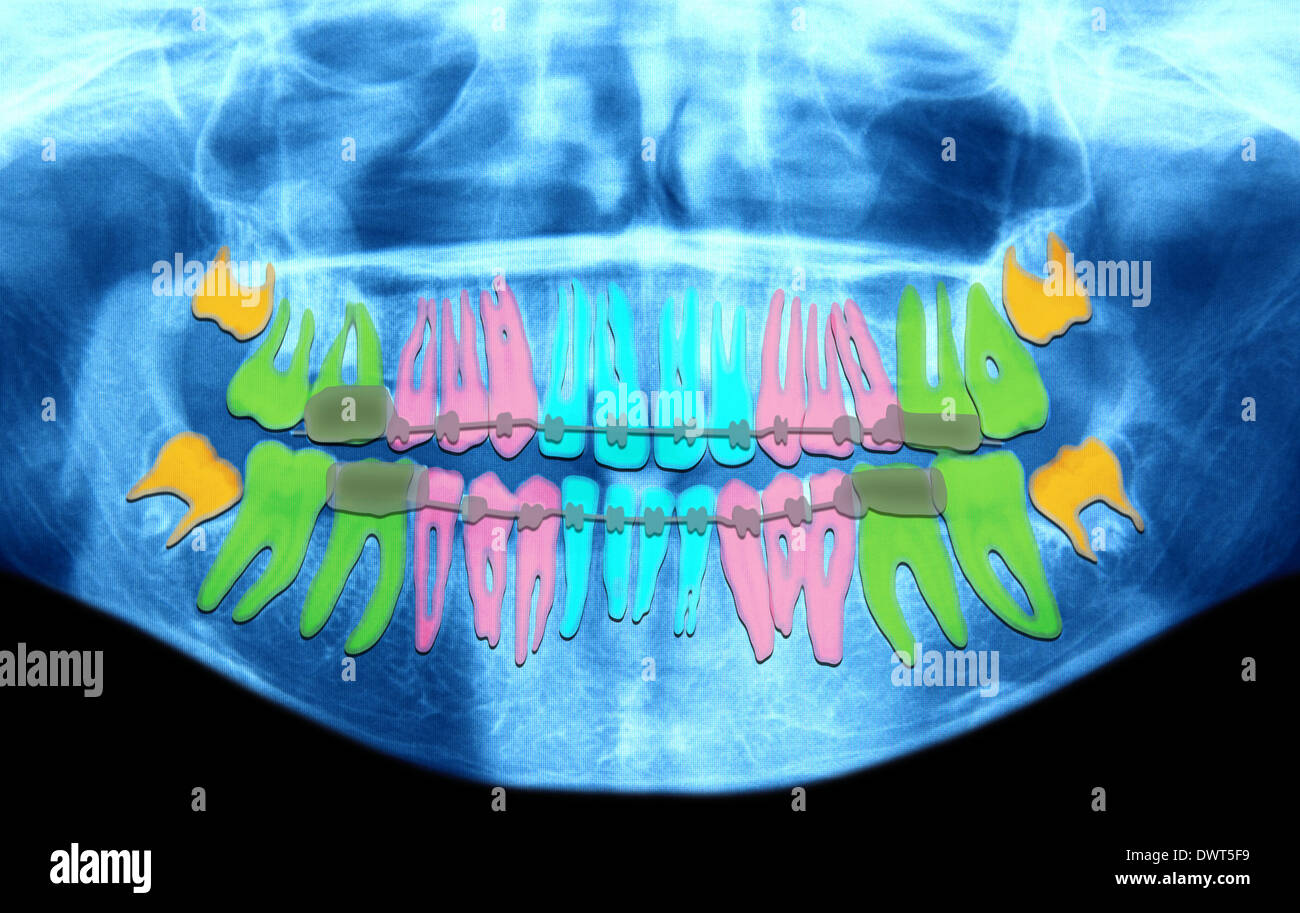 Dental apparatus hires stock photography and images Alamy