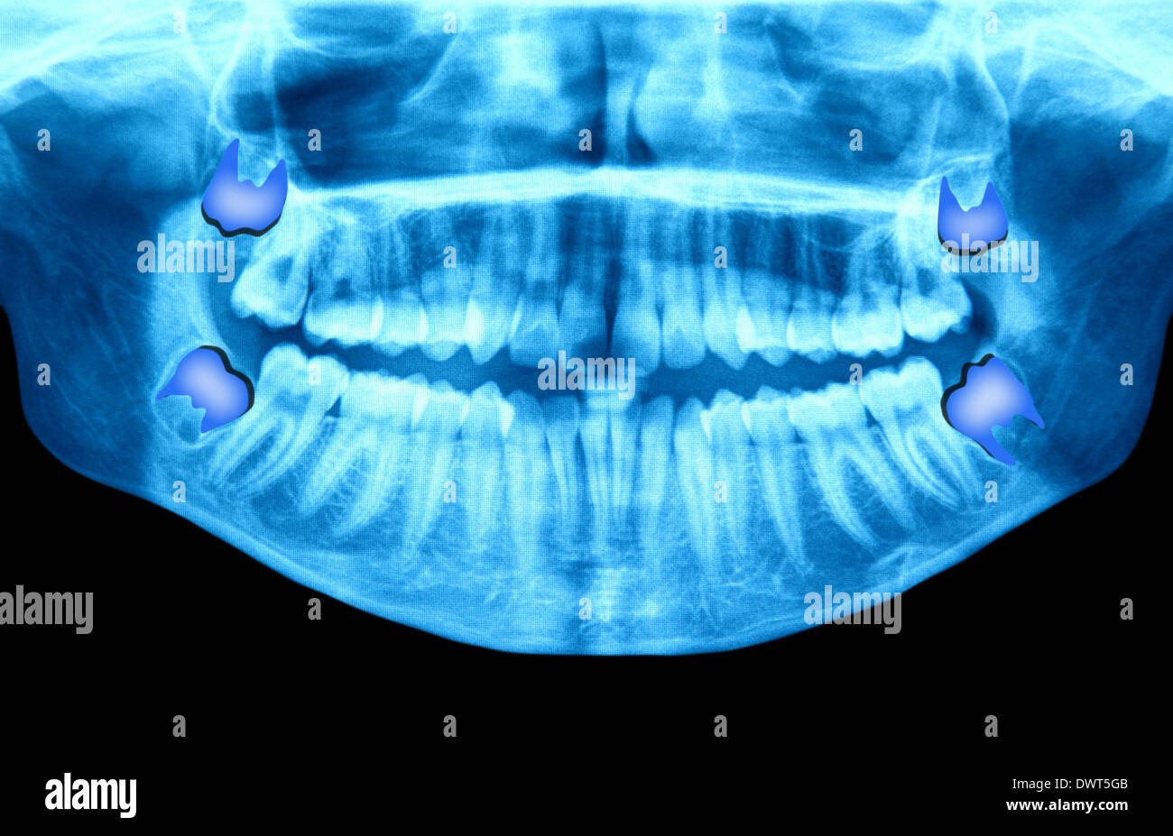 Embedded Tooth Panoramic Definitive Tooth High Resolution Stock Photography and Images - Alamy