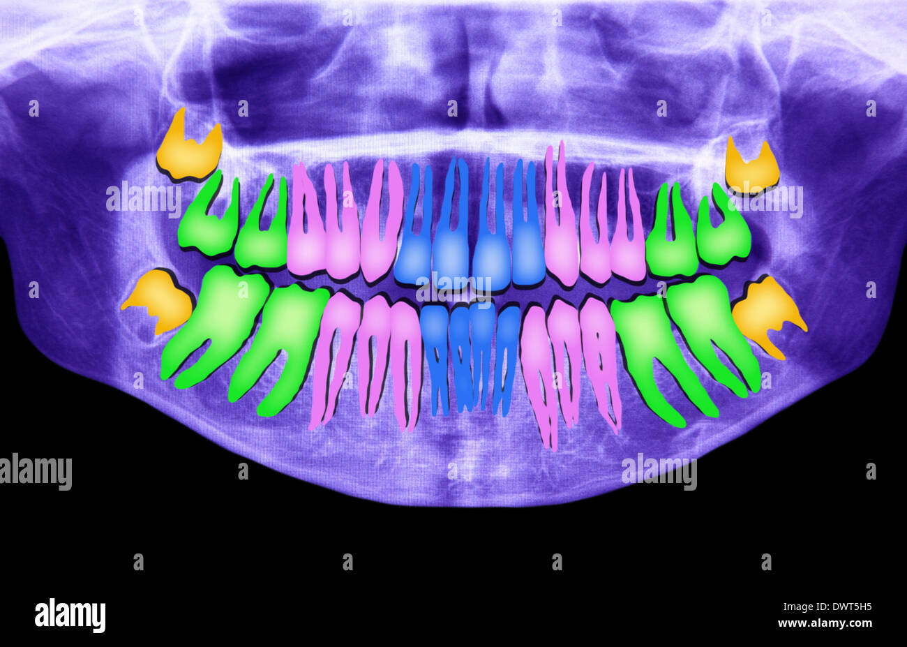 Embedded Tooth Panoramic Definitive tooth hi-res stock photography and images - Alamy