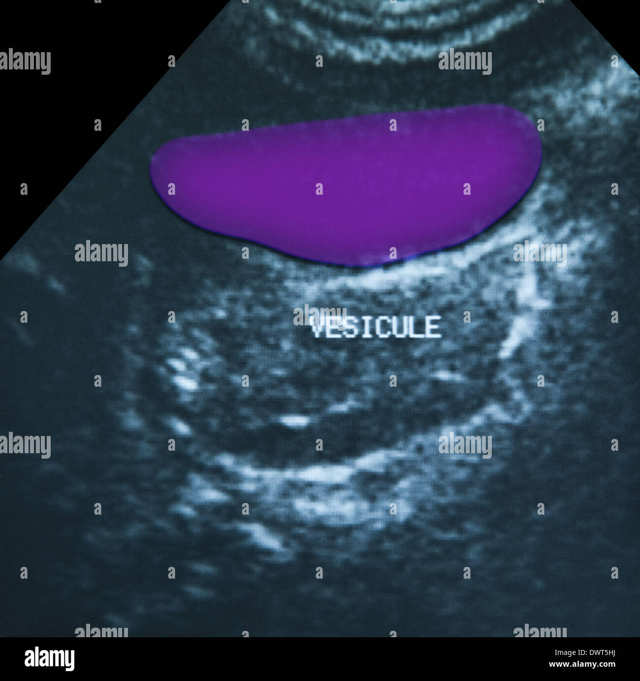 Gallbladder ultrasound hires stock photography and images Alamy