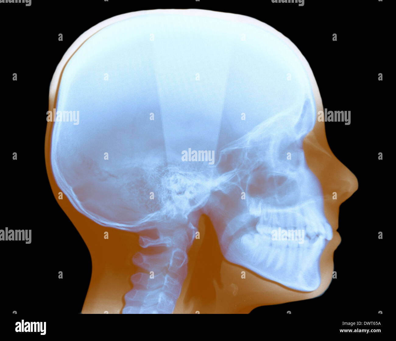 Head x ray Stock Photo Alamy