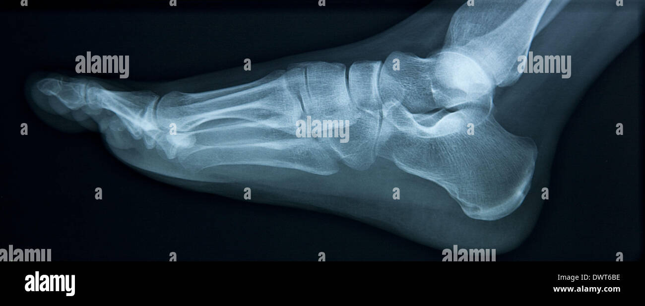 Flat foot x ray Stock Photo