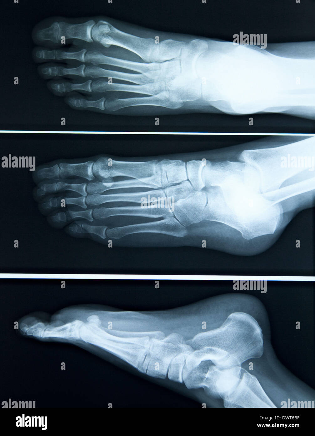 Flat foot x ray Stock Photo