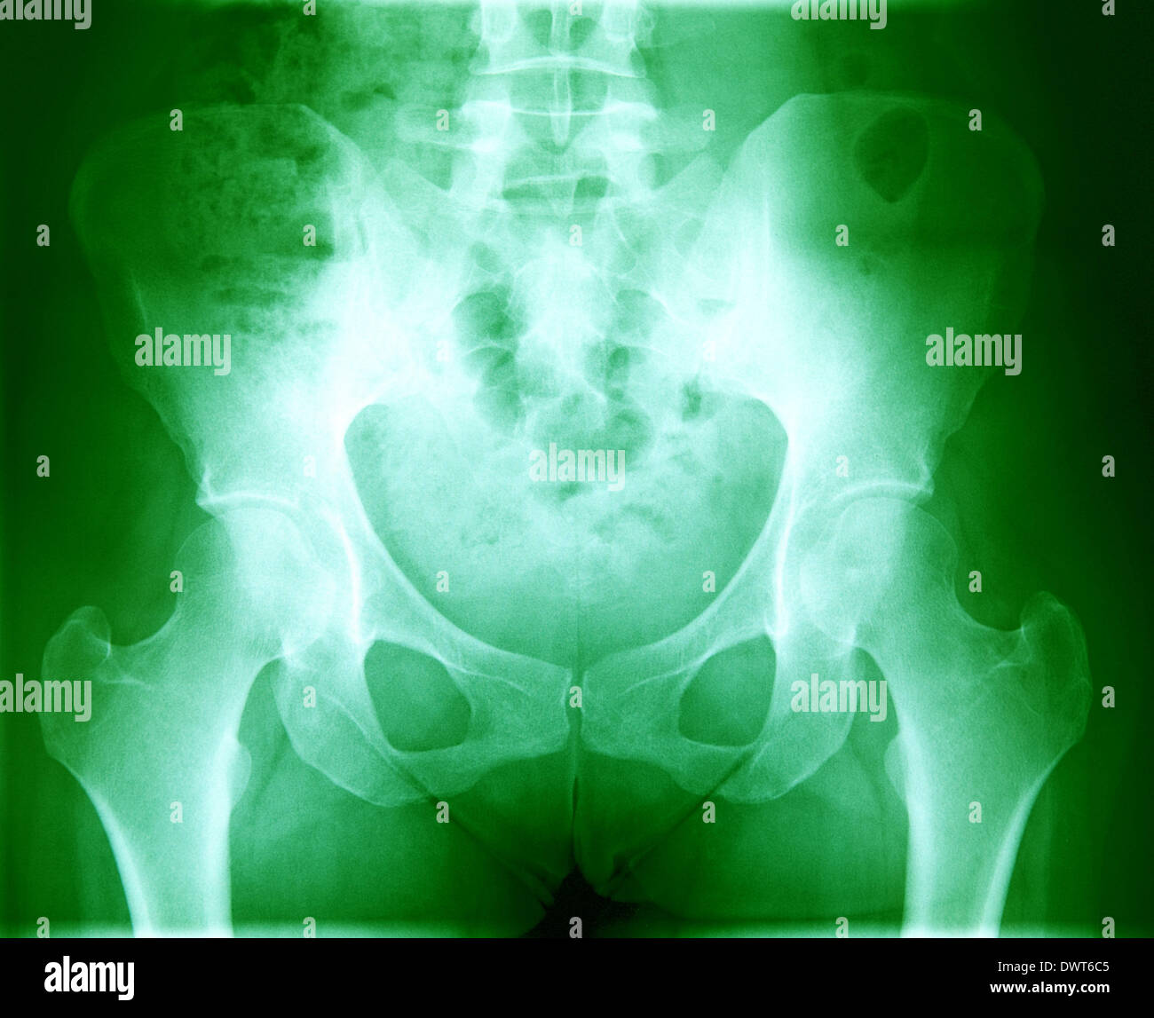 Pelvis x ray Stock Photo