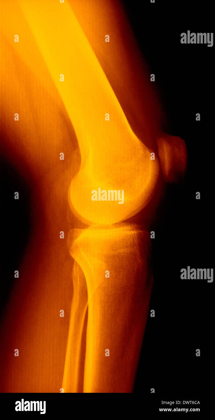Knee x ray Stock Photo Alamy