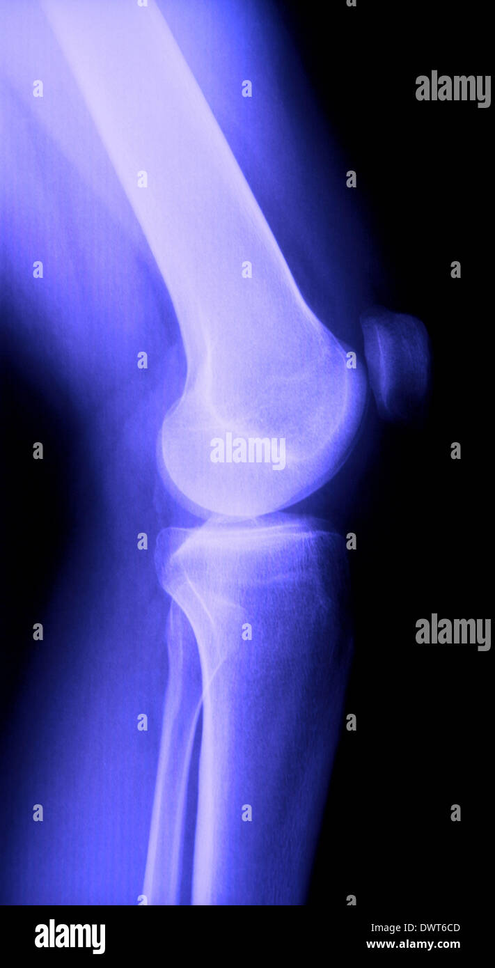 Knee x ray Stock Photo Alamy