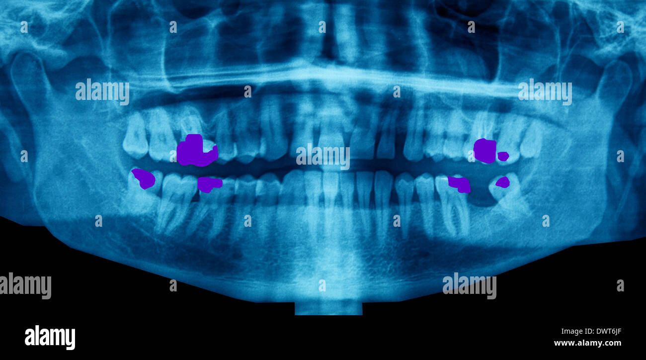 Dental x ray amalgam hi-res stock photography and images - Alamy