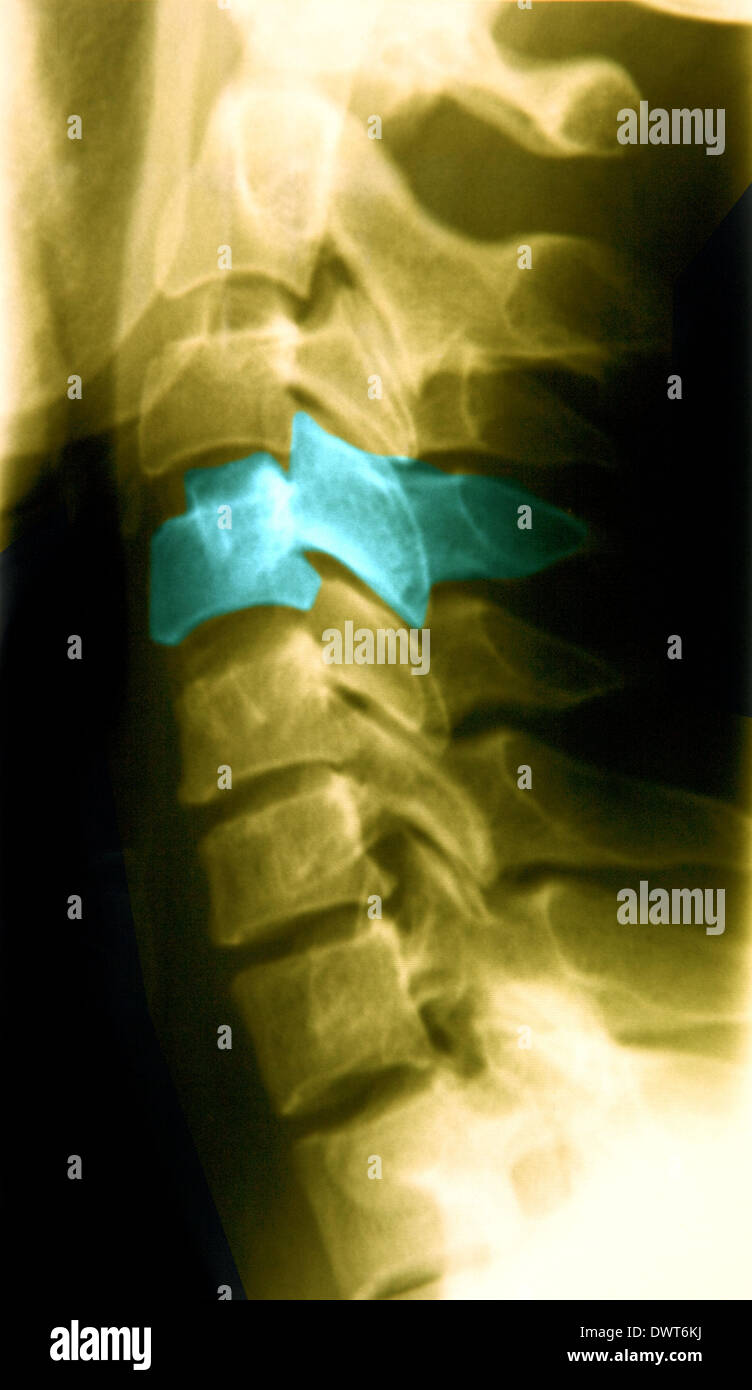 Cervical vertebra x ray Stock Photo - Alamy