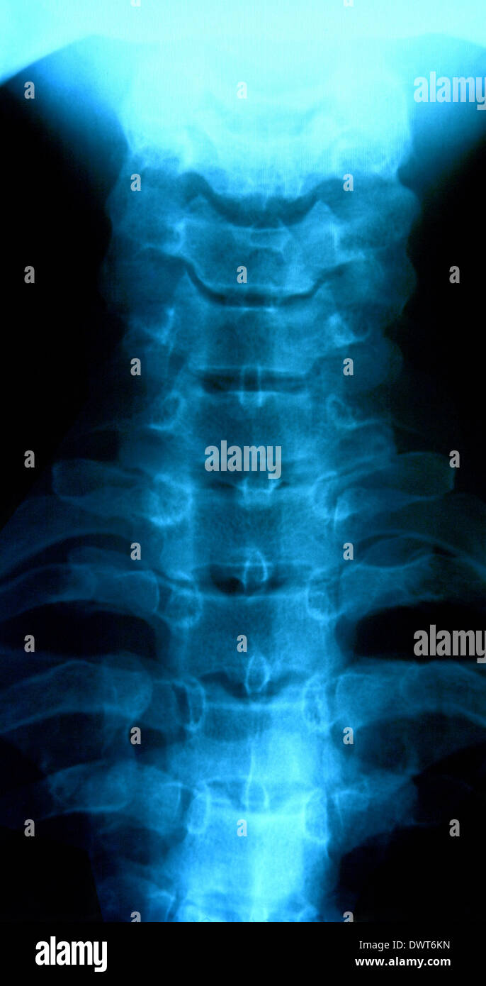 X ray cervical spine hi-res stock photography and images - Alamy