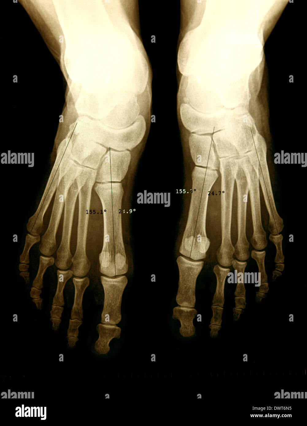 Foot x ray Stock Photo - Alamy