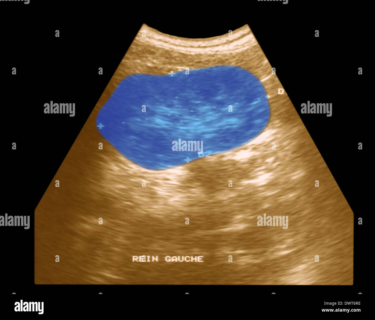 Kidney ultrasound scan Stock Photo - Alamy