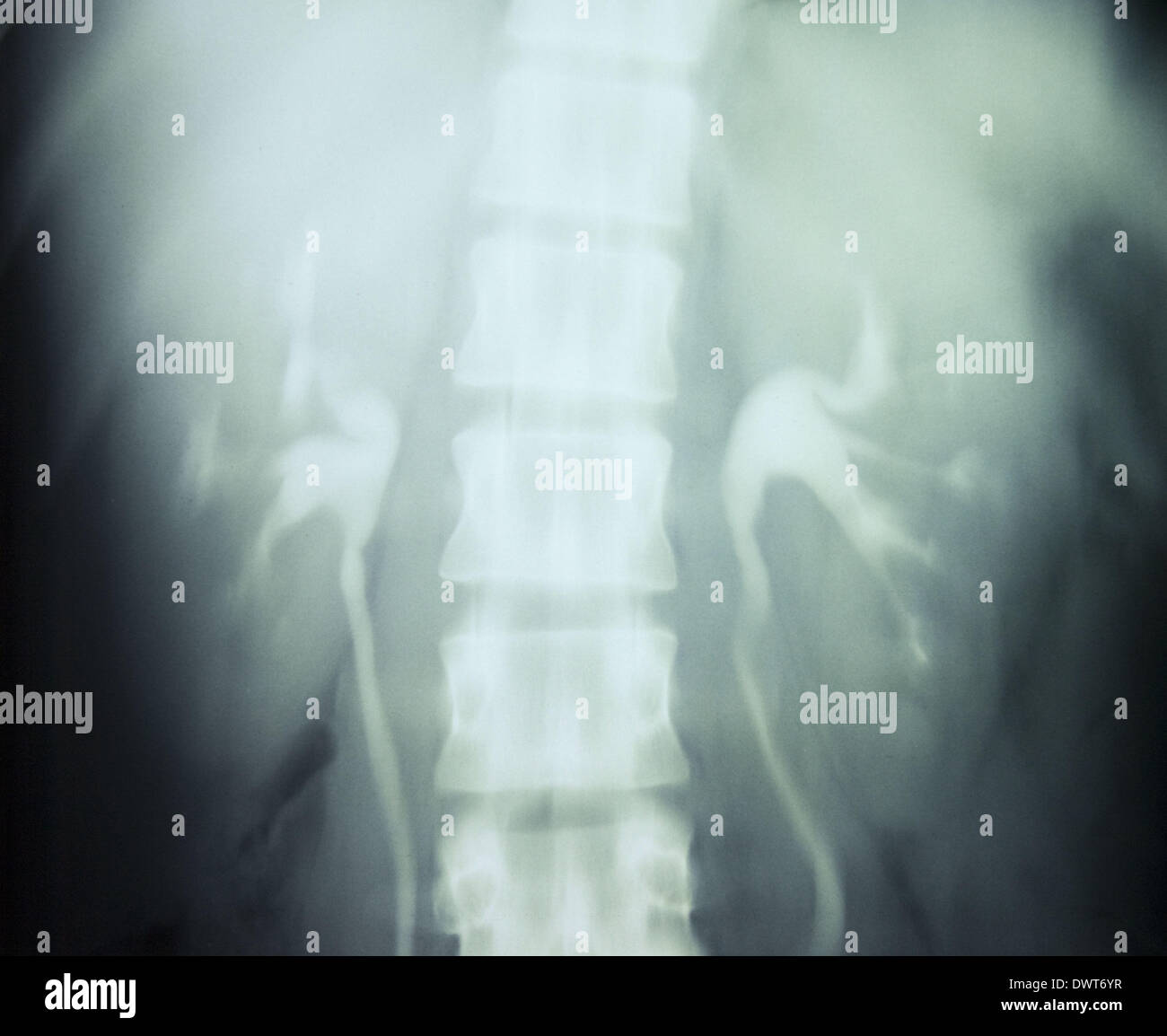 Urinary system x ray Stock Photo