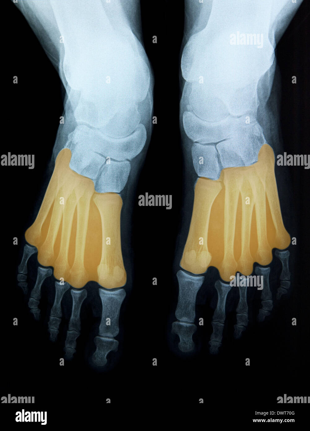 Foot x ray Stock Photo Alamy