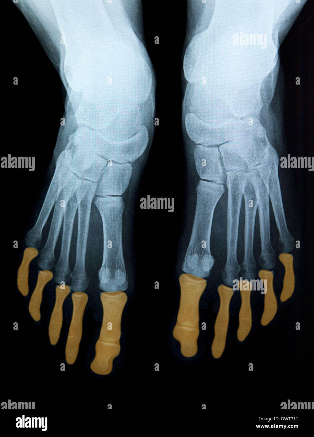 Foot x ray Stock Photo