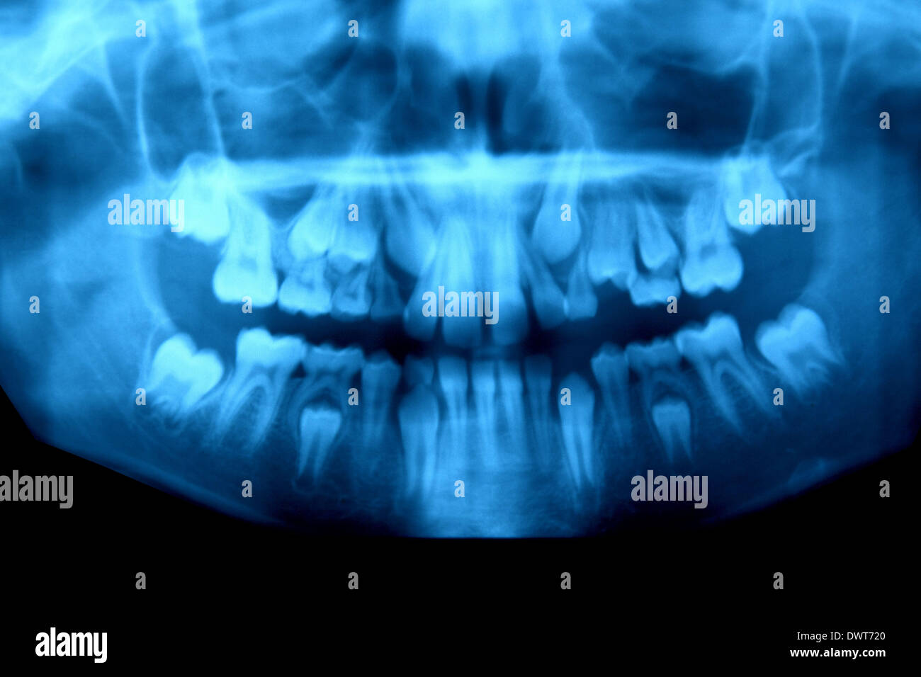 Embedded Tooth Panoramic Definitive Tooth High Resolution Stock Photography and Images - Alamy