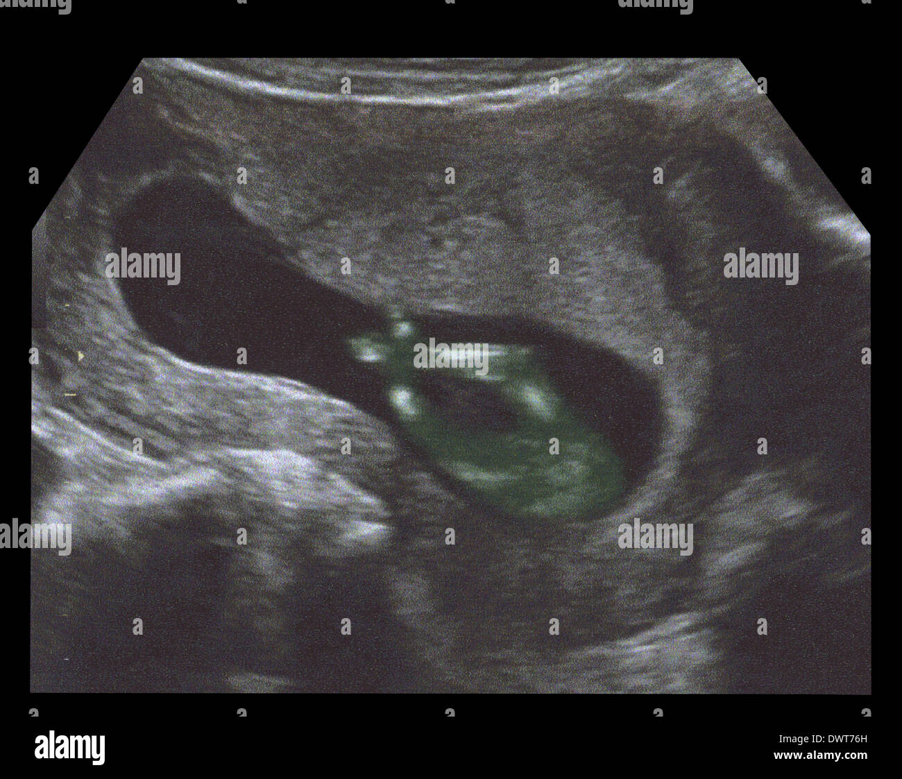 Fetus ultrasound scan Stock Photo - Alamy