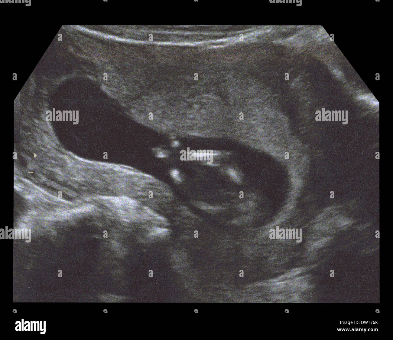 Fetus ultrasound scan Stock Photo - Alamy
