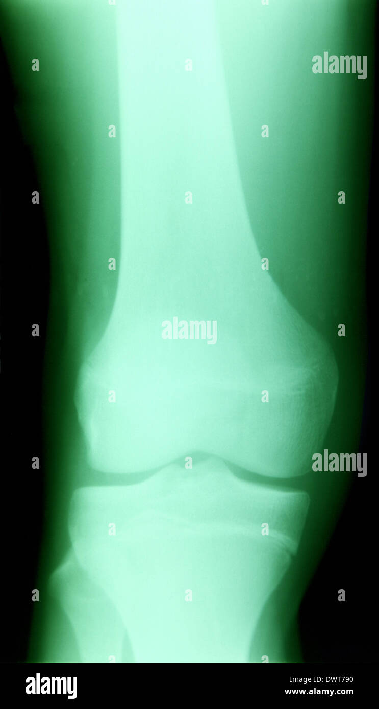 Child knee x ray hires stock photography and images Alamy