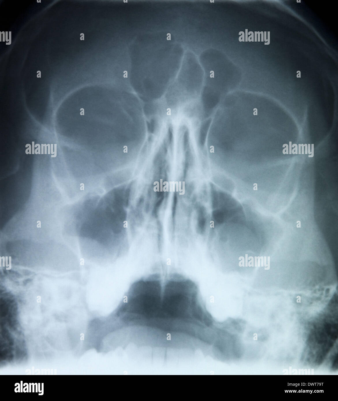 Paranasal Sinuses X Ray