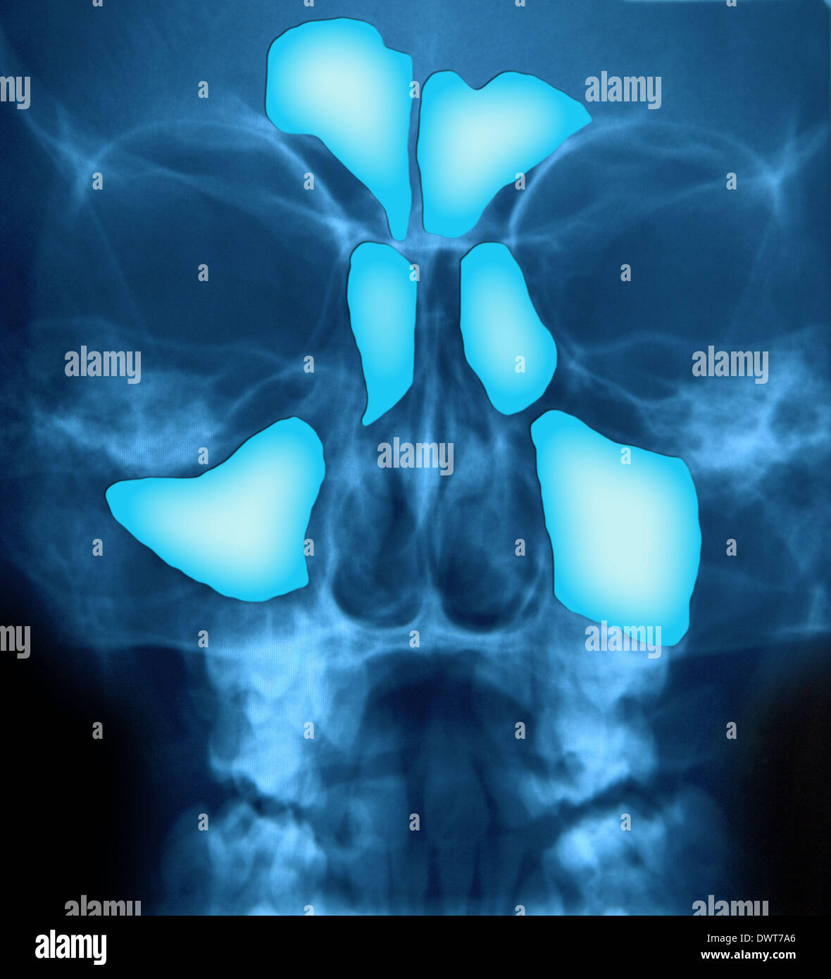 Sinus x ray Stock Photo Alamy