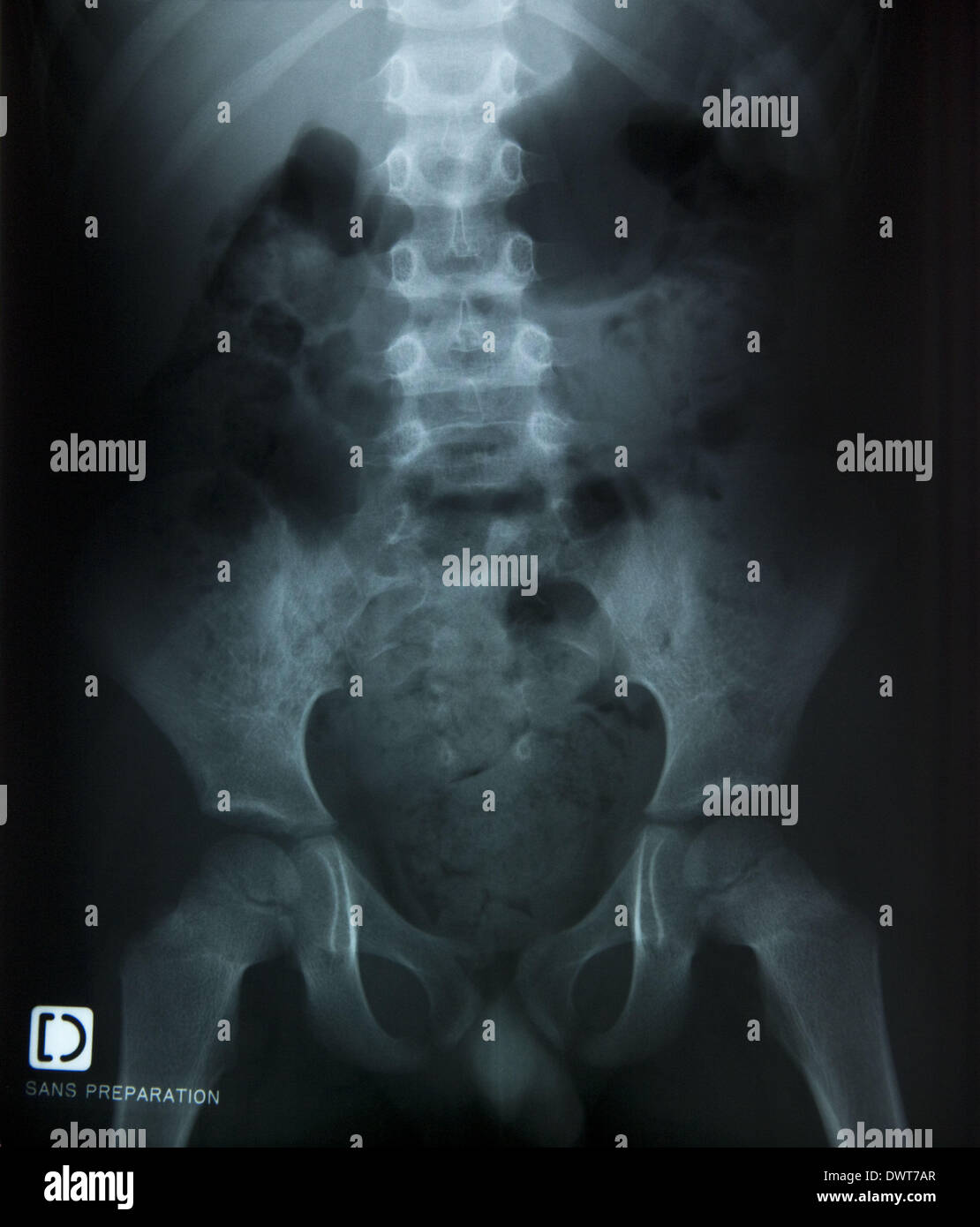 Retrograde cystography Stock Photo