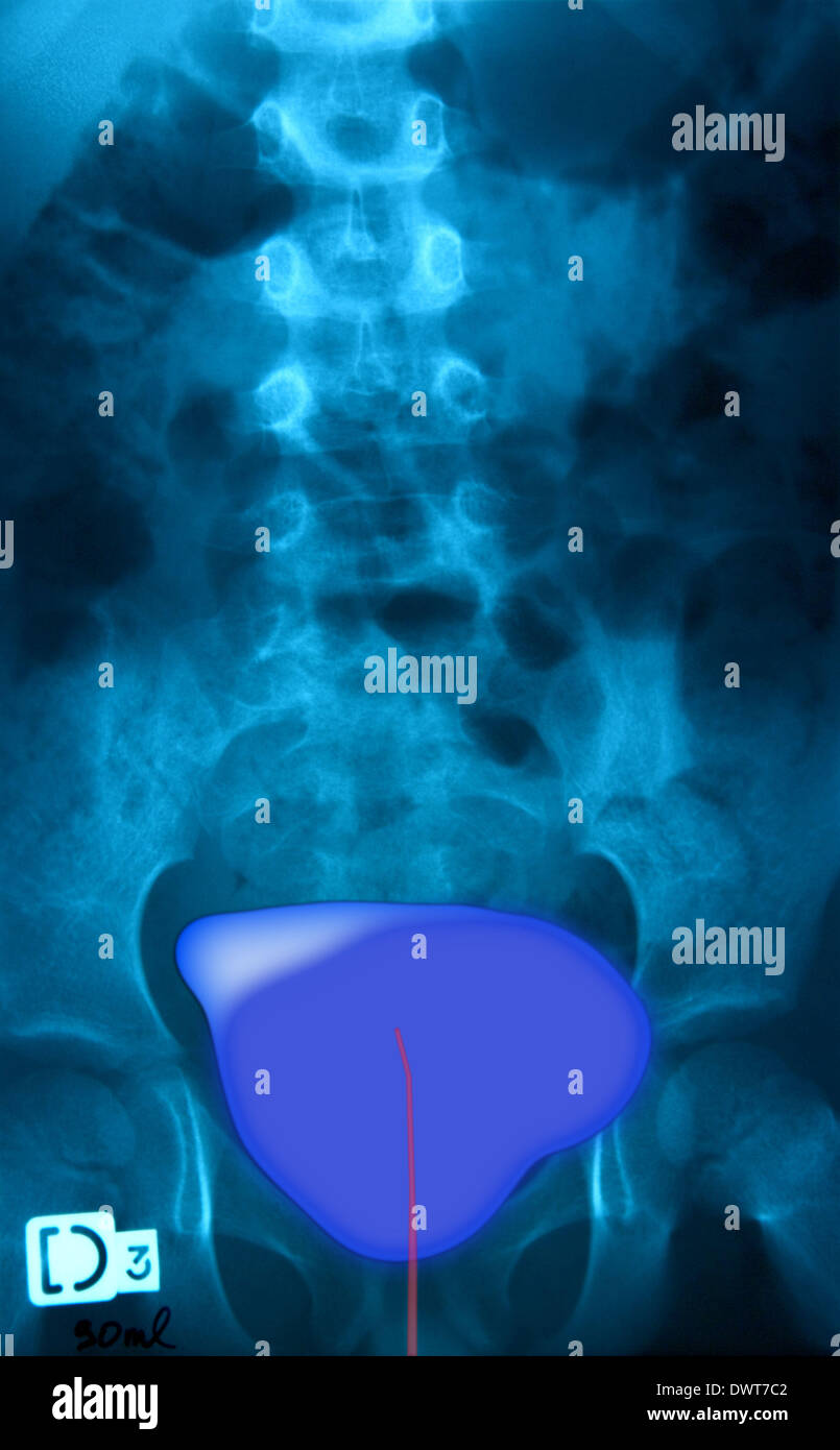 Traditional Cystogram Cystography hi-res stock photography and images - Alamy