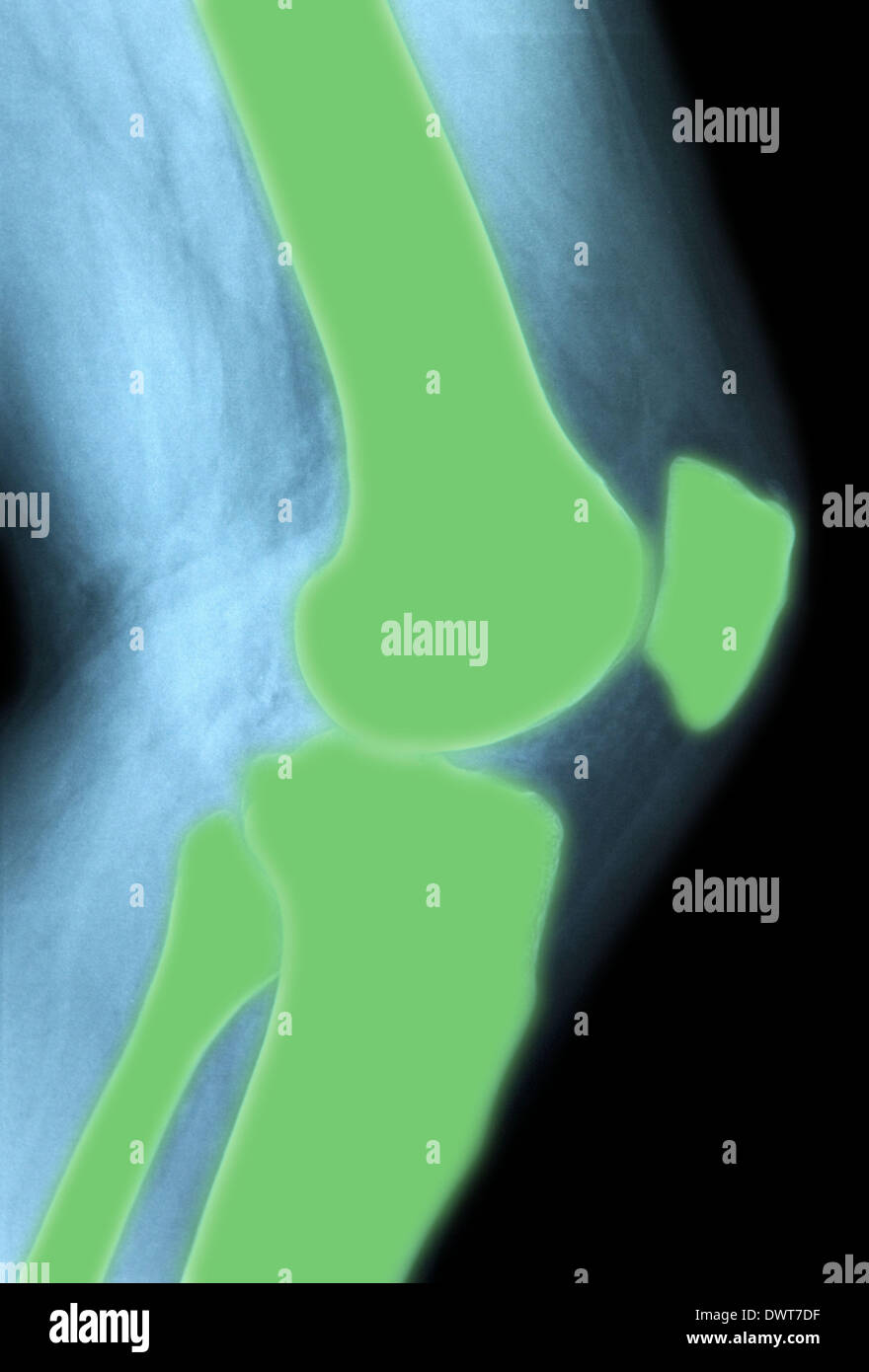 Knee x ray Stock Photo Alamy