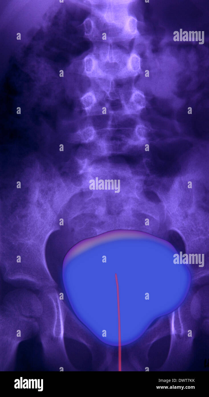 Retrograde cystography Stock Photo