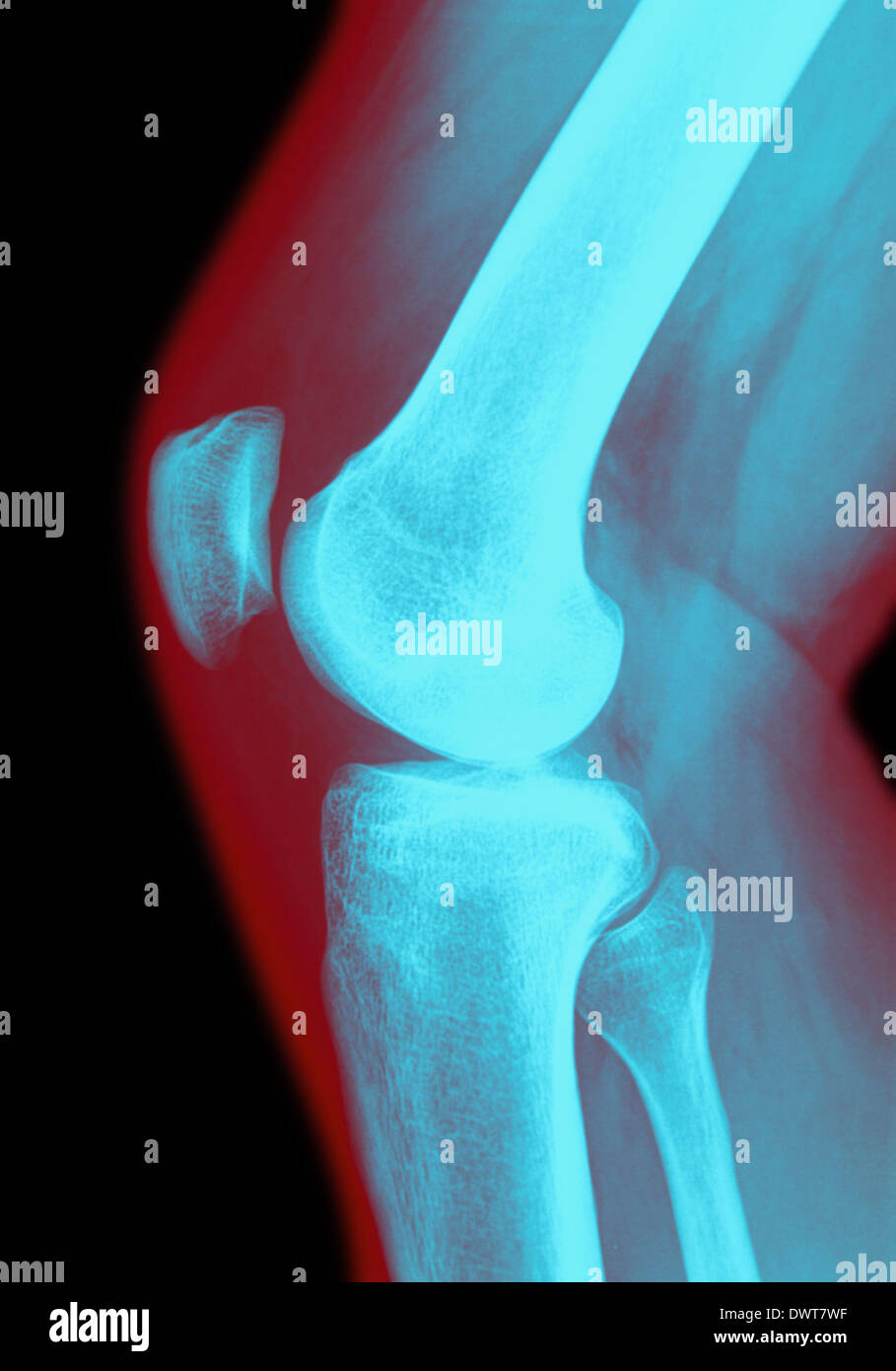 Knee x ray Stock Photo Alamy