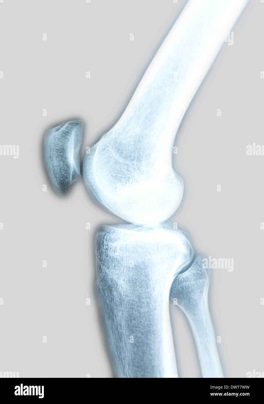 Knee x ray Stock Photo - Alamy