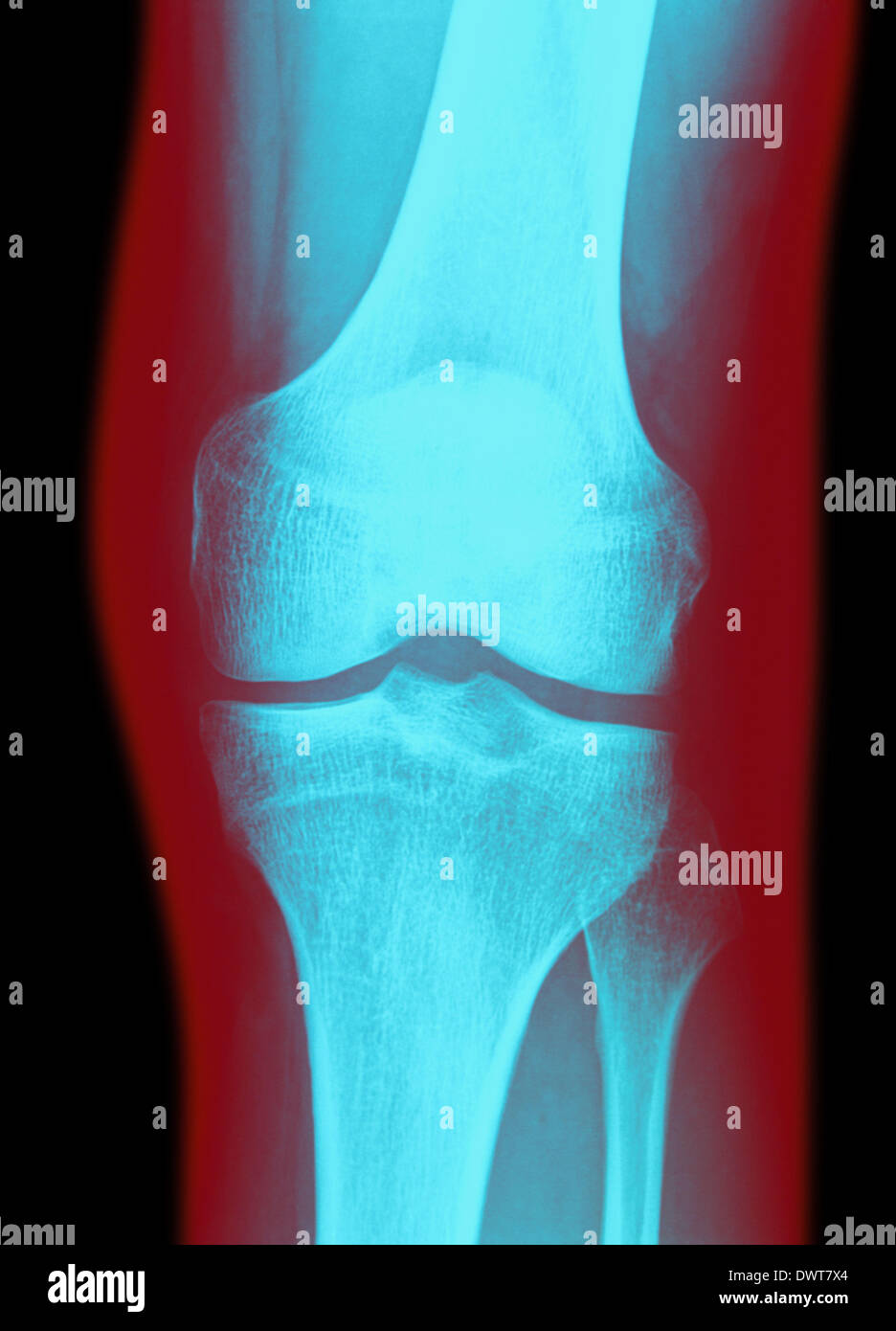 Knee x ray Stock Photo Alamy