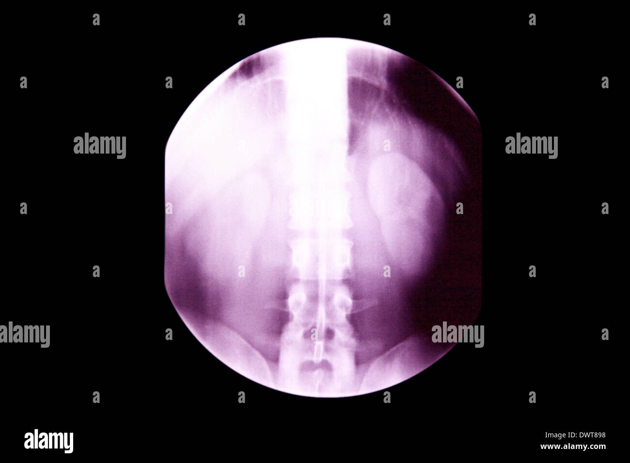 Kidney x ray Stock Photo Alamy
