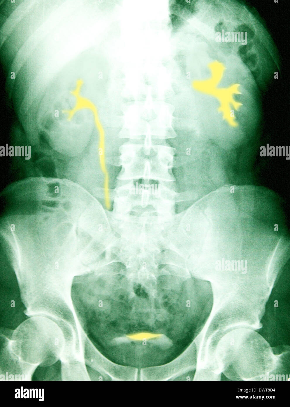 Urinary system x ray Stock Photo Alamy