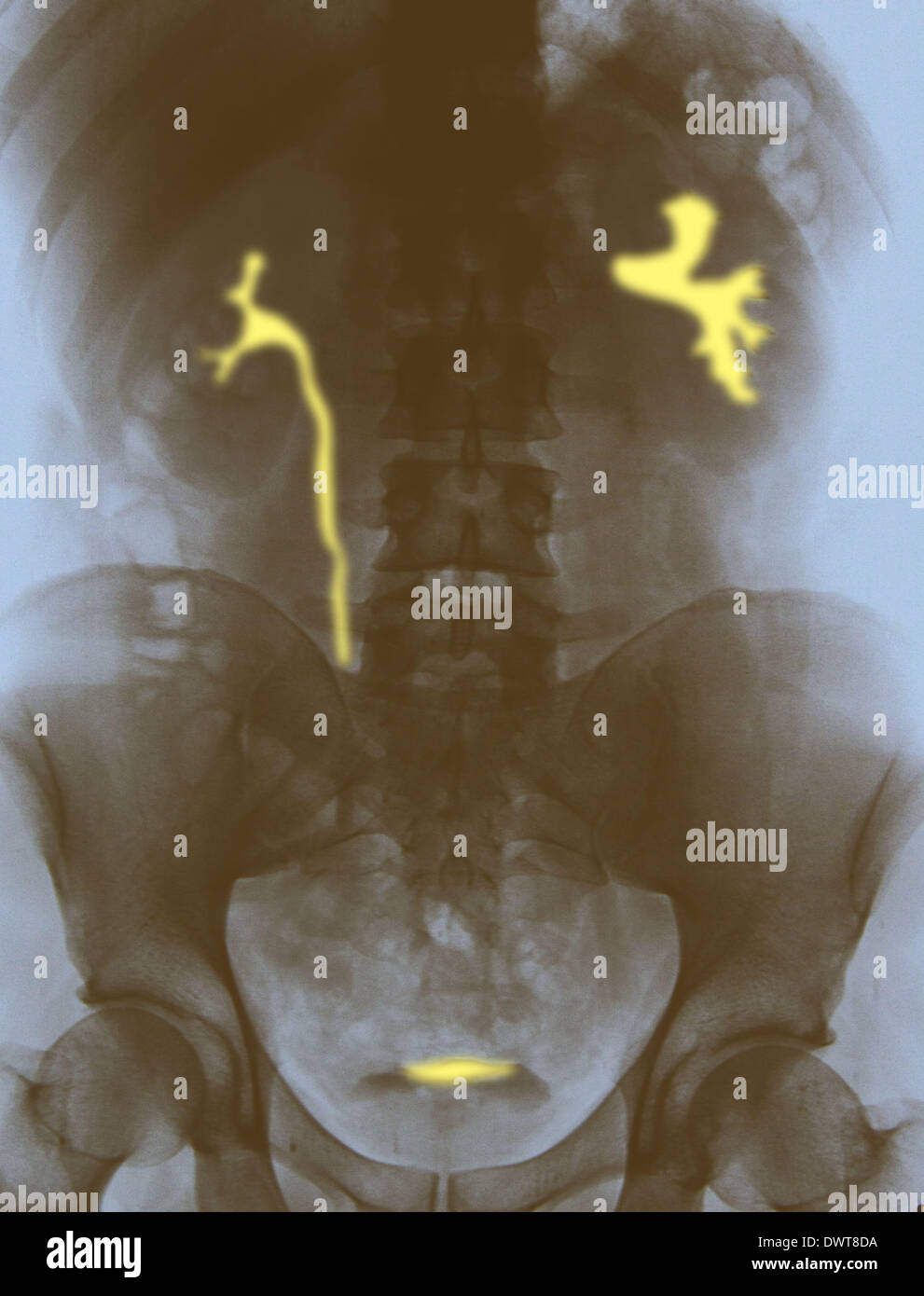 Urinary system x ray Stock Photo Alamy