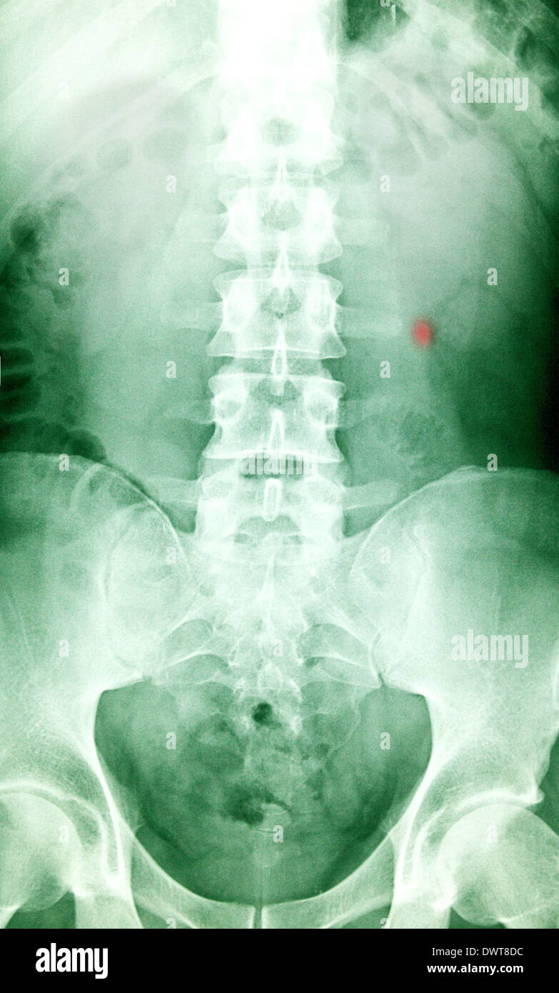 Kidney stone x ray Stock Photo Alamy