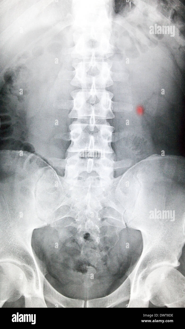 Kidney stone x ray Stock Photo 67531002 Alamy