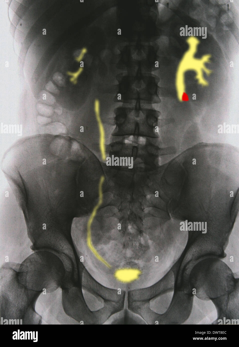 Kidney stone x ray Stock Photo Alamy
