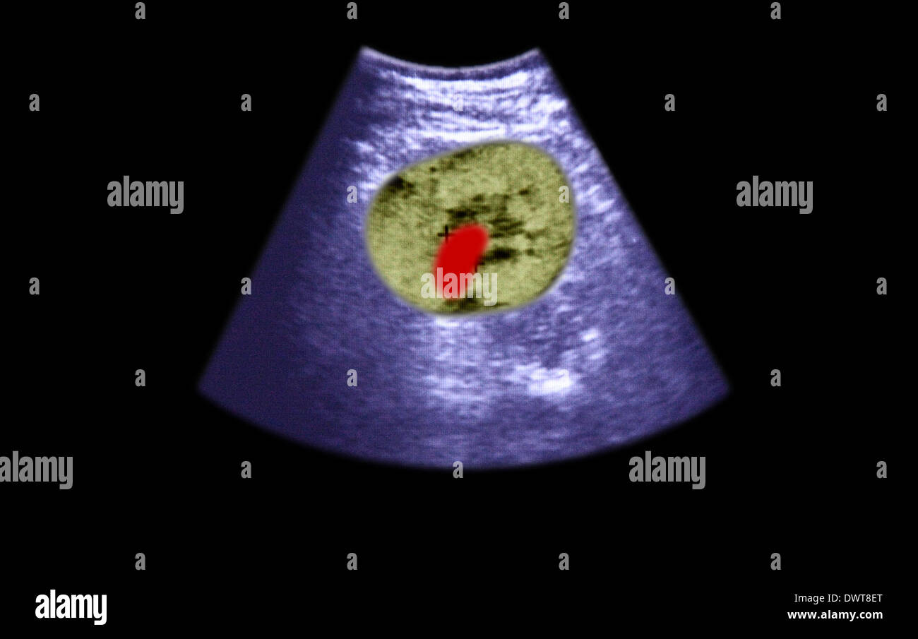 Kidney stone ultrasound scan Stock Photo