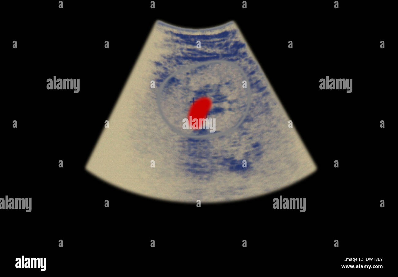 Kidney stone ultrasound scan hires stock photography and images Alamy