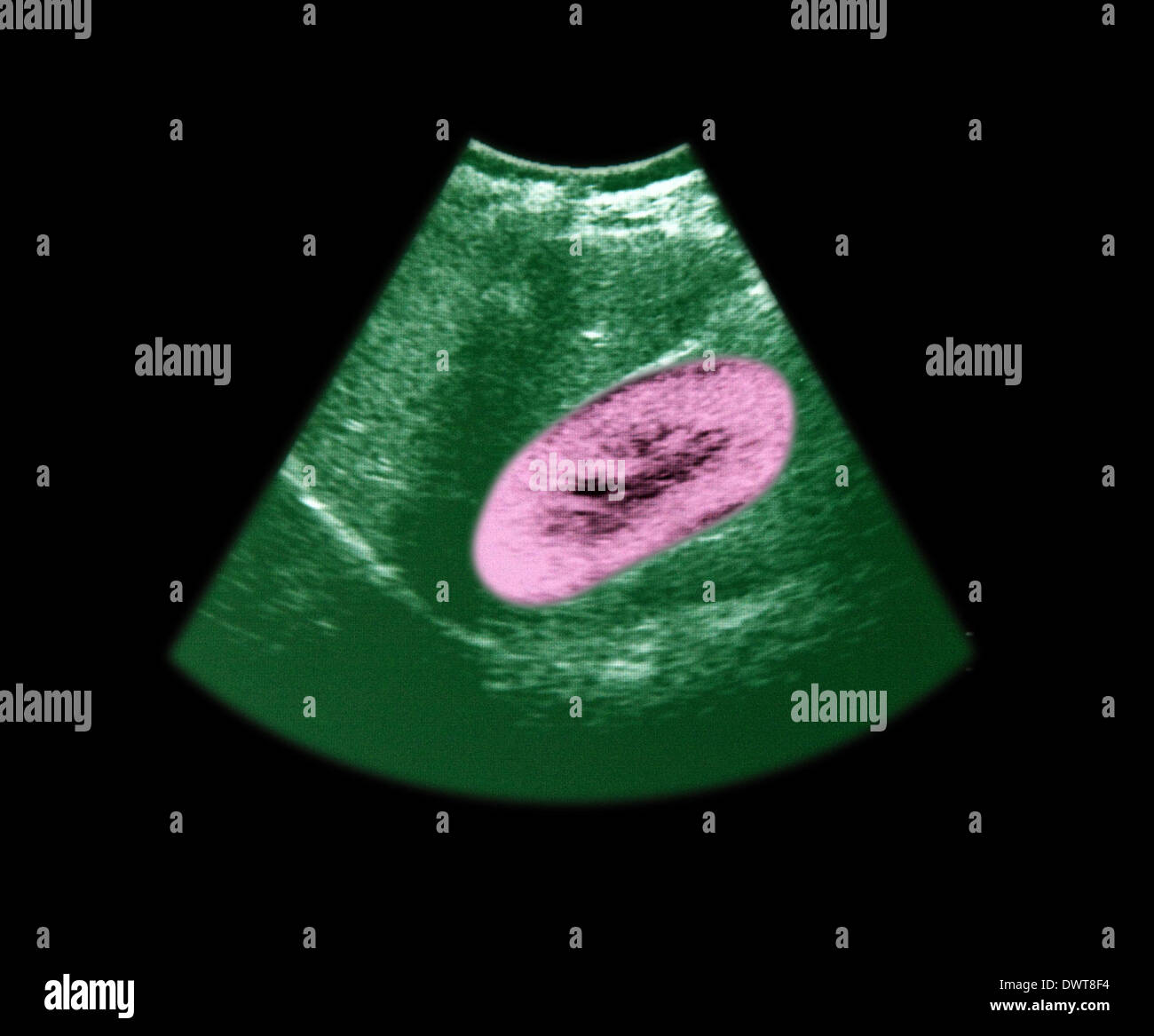 Kidney ultrasound scan Stock Photo